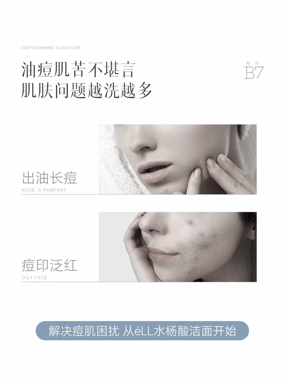 ELL Eucalyptus Salicylic Acid Oil Control Acne Cleansing Foam 100g ELL蓝桉叶水杨酸控油净痘洁面乳