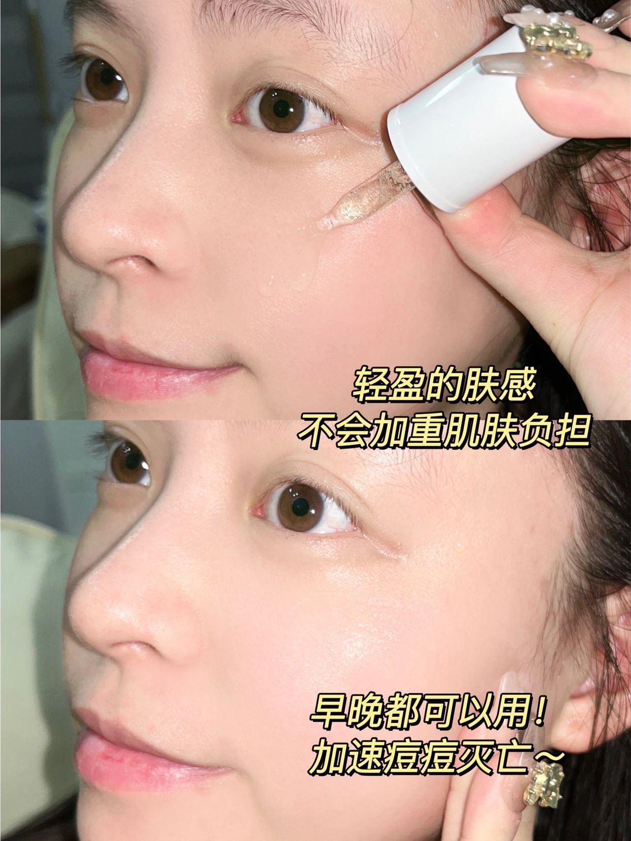 FulQun Acne Clearing and Relieving Essence 30ml 芙清清痘舒缓精华液
